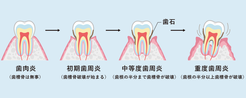 歯周病の原因と進行