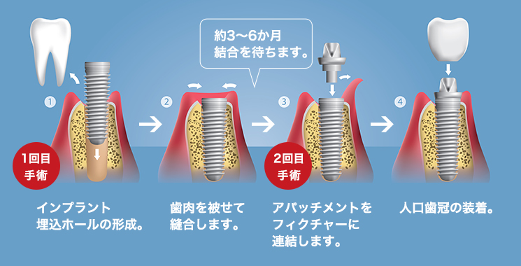 インプラント治療の手順