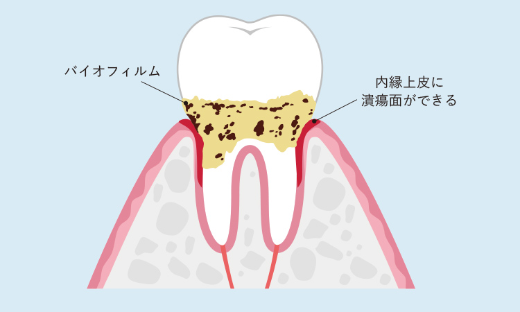 歯周病の発症について