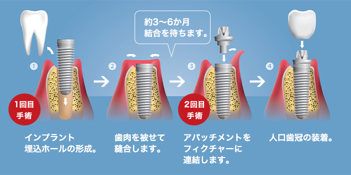 インプラント治療の手順